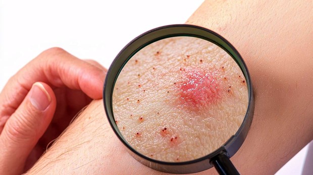 Hudcancer missades - bed�mdes via chat